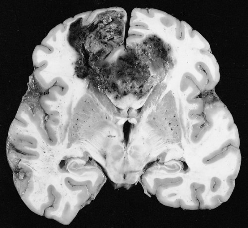 Glioblastoma multiforme