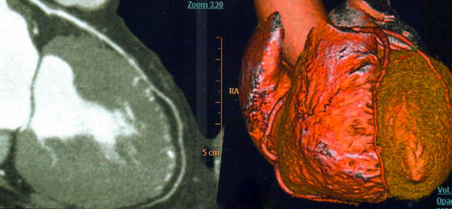 ANGIO TAC Coronarica: Una nuova metodologia di diagnosi non invasiva