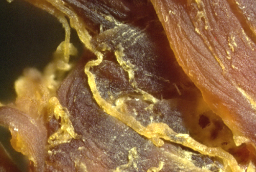 fibrous-clot-100x-png