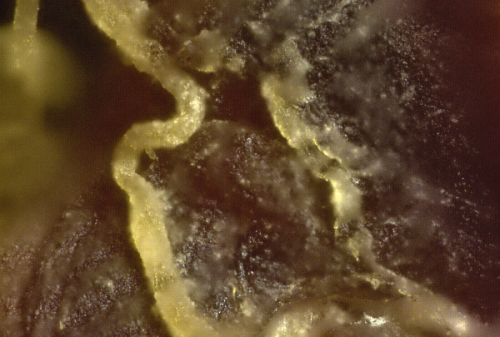 fibrous-clot-200x-png