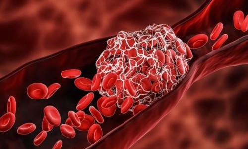 two-new-stunning-discoveries-found-in-blood-clots-from-the-covid-vaccinated-blood-clot-arm-2